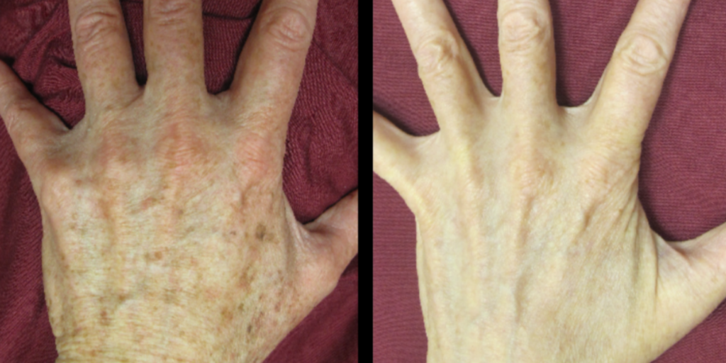anti aging hand treatment at London real skin