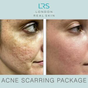Acne Scarring Package