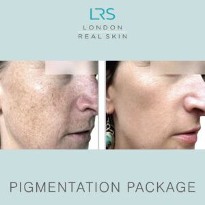 Pigmentation Package