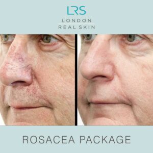 Redness and Rosacea Package