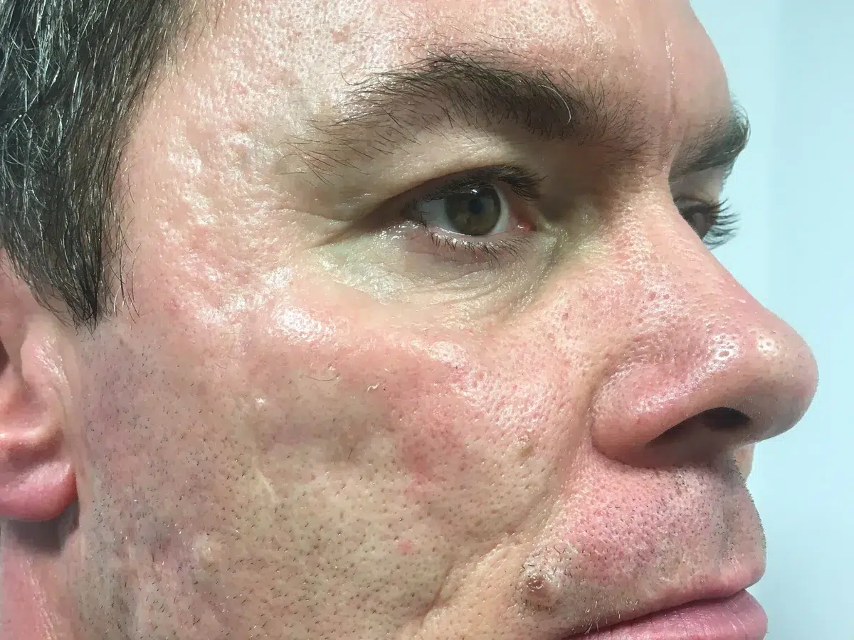 Extensive scarring across cheek and jaw, before treatment at London Real Skin