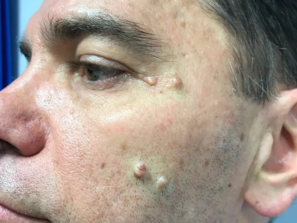 acp electrolysis 3 before