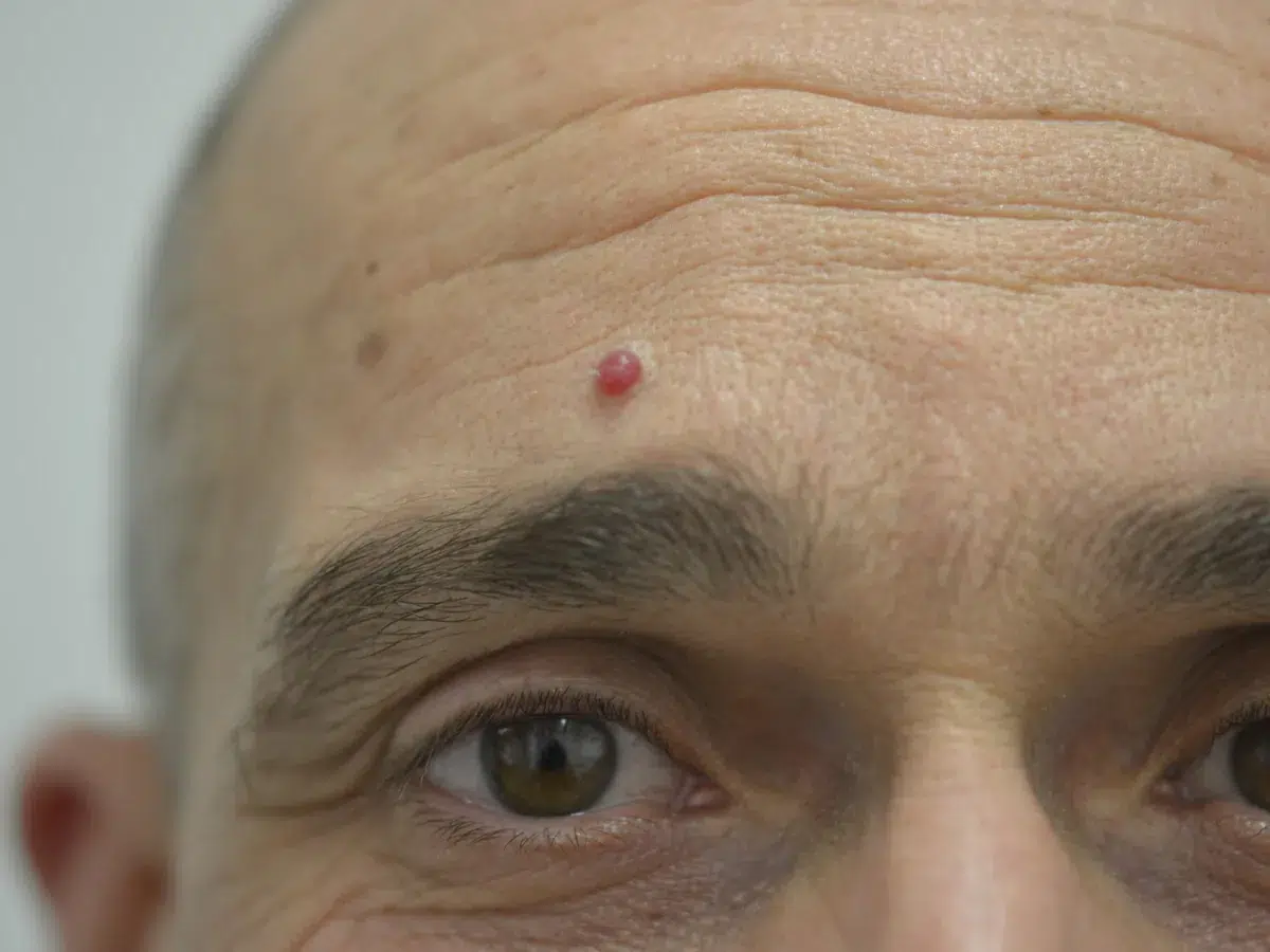 acp electrolysis before