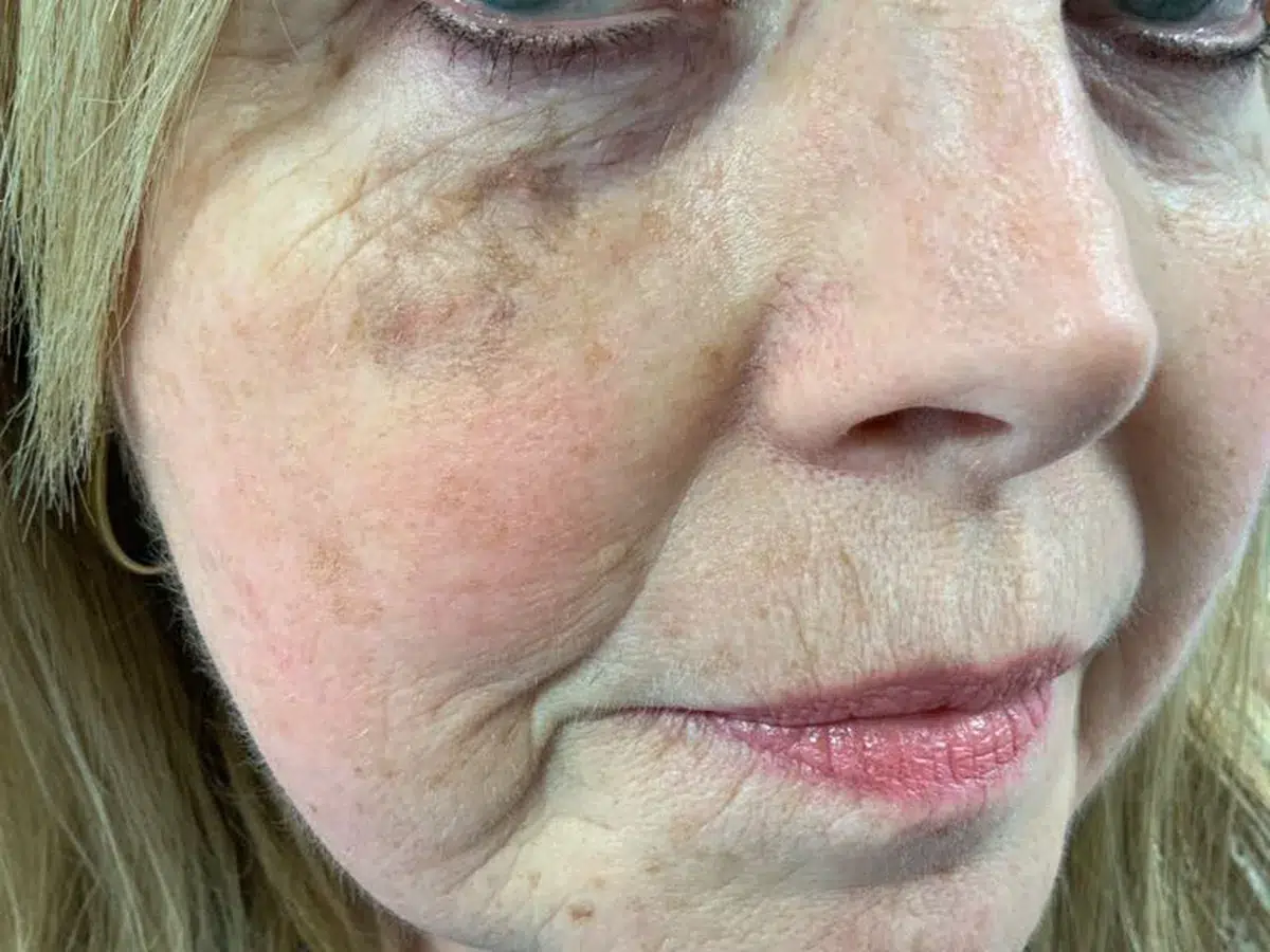 Sun damage and age spots on the face, before treatment at London Real Skin