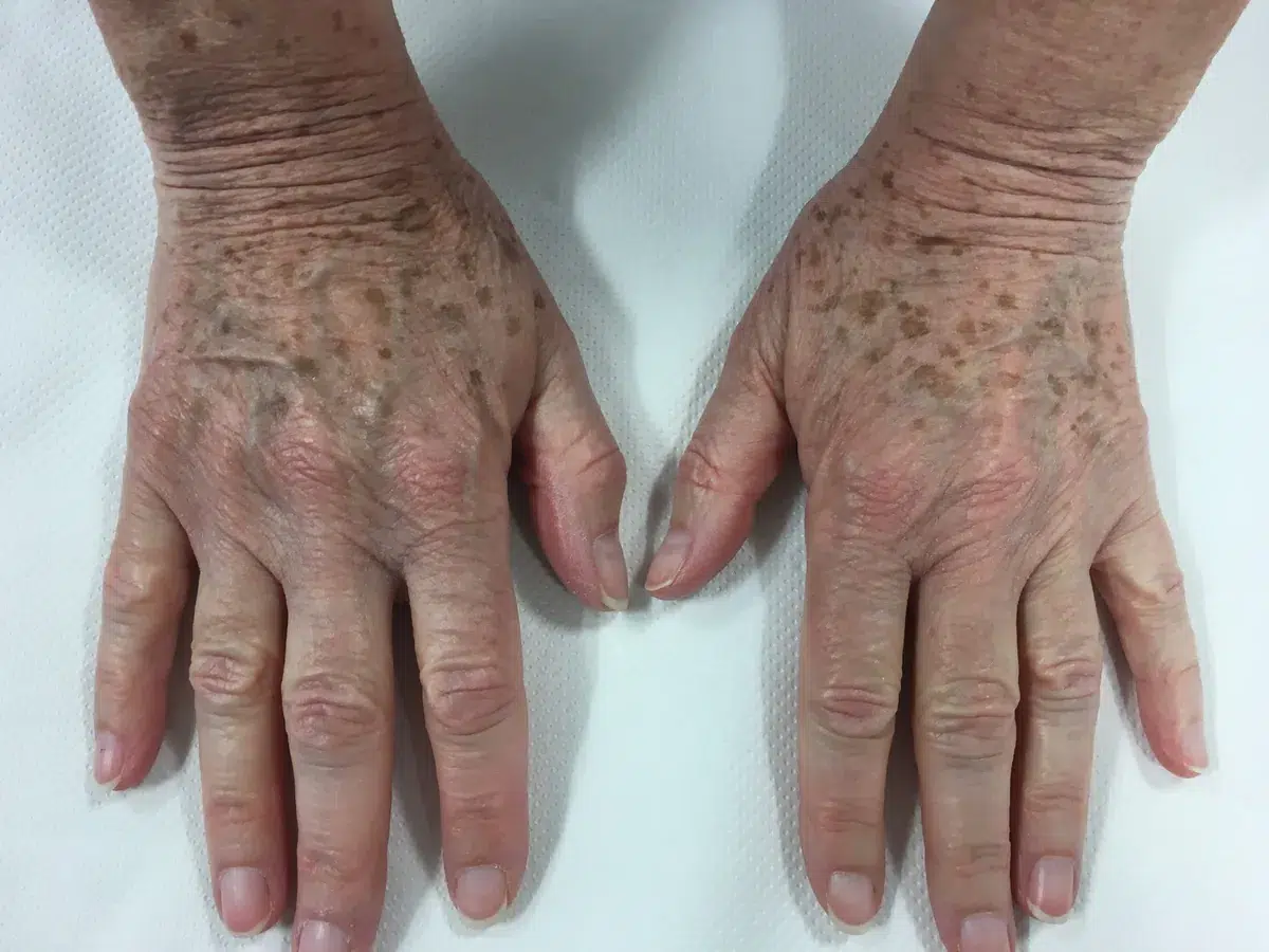 Age spots on the hands, before treatment at London Real Skin