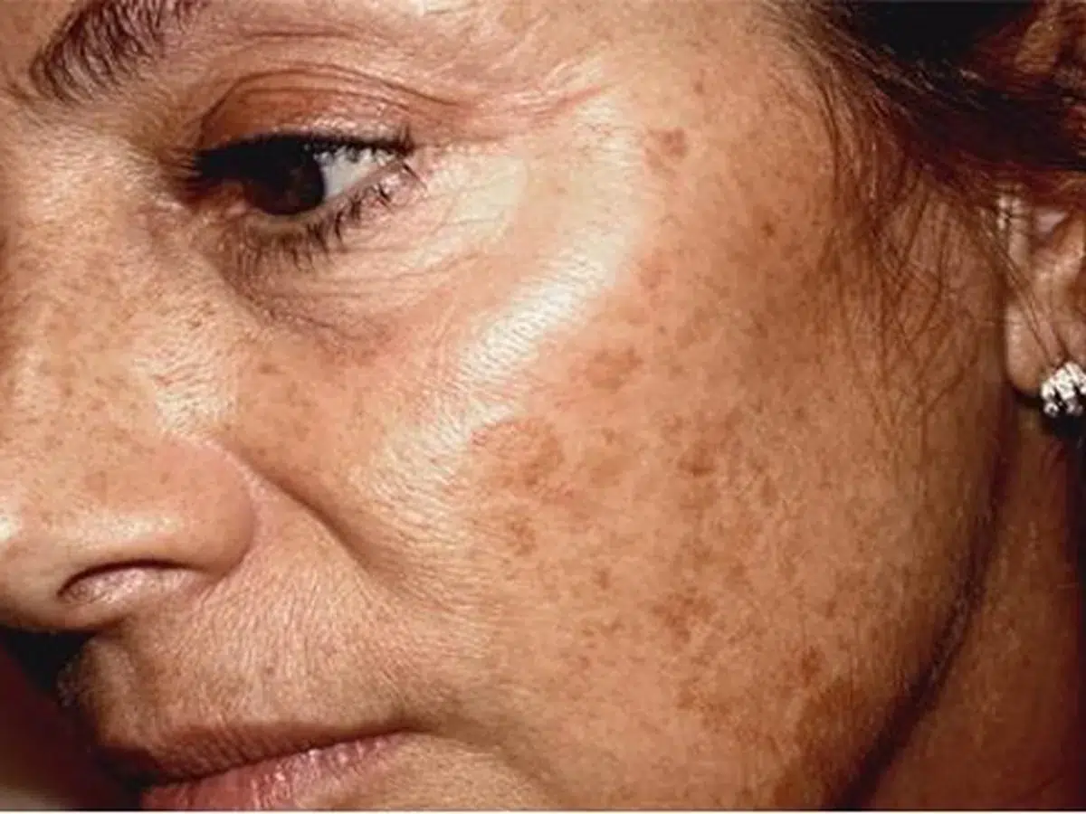 Dense facial pigmentation, before treatment at London Real Skin