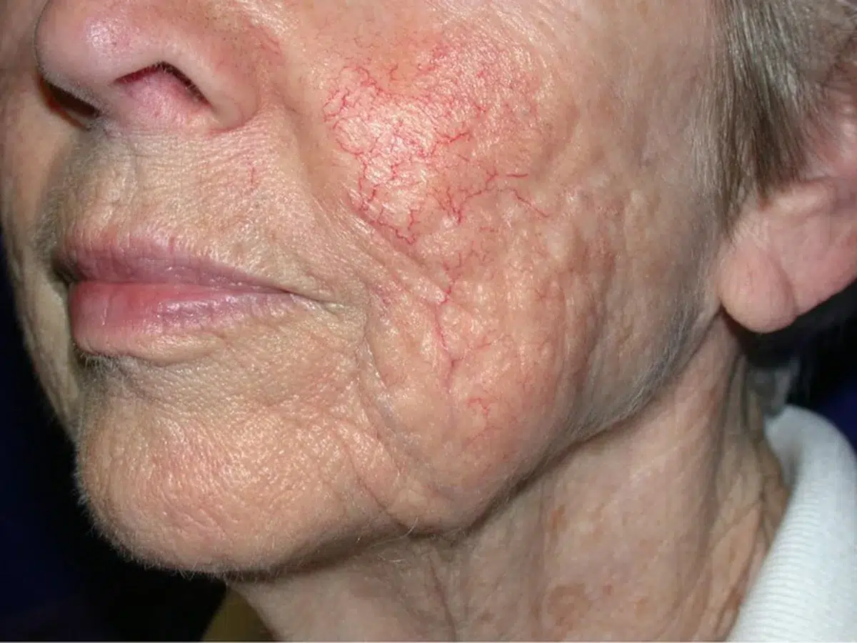 Thread veins across the cheeks, before treatment at London Real Skin