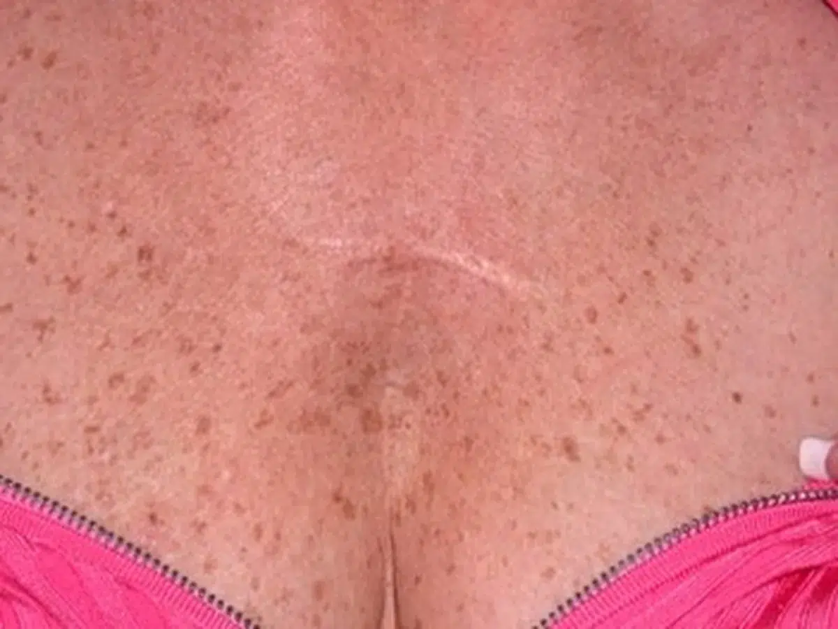 Freckling across the chest, before treatment at London Real Skin