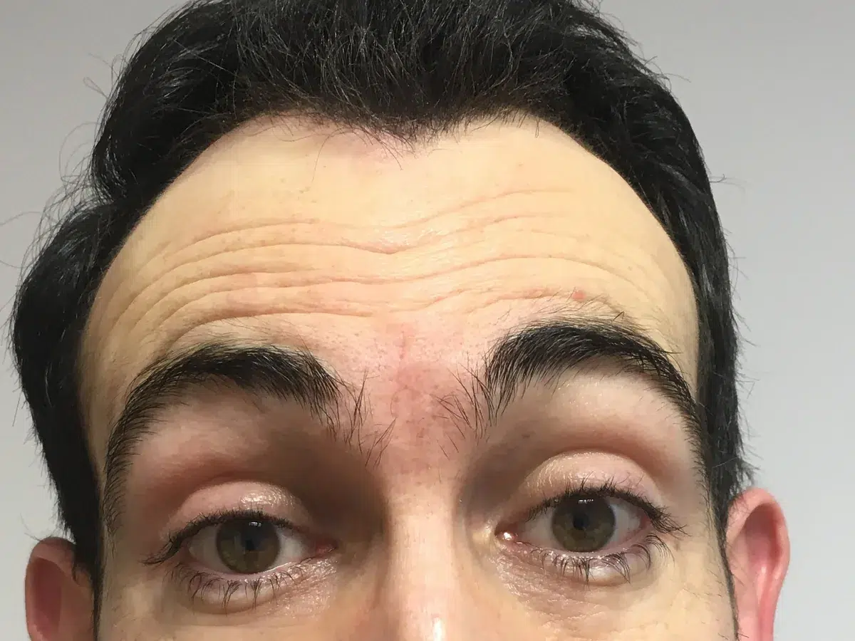 Deep horizontal forehead lines, before treatment at London Real Skin