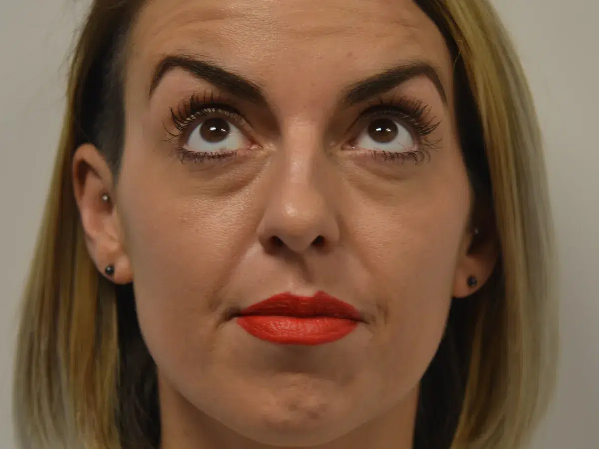 Treated lines seen in movement, before treatment at London Real Skin