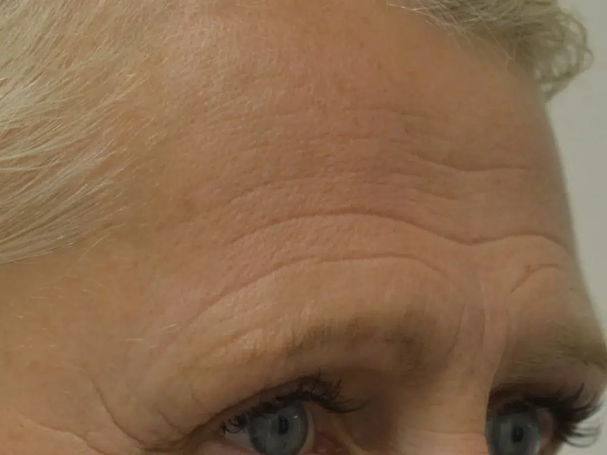 Horizontal forehead lines, before treatment at London Real Skin