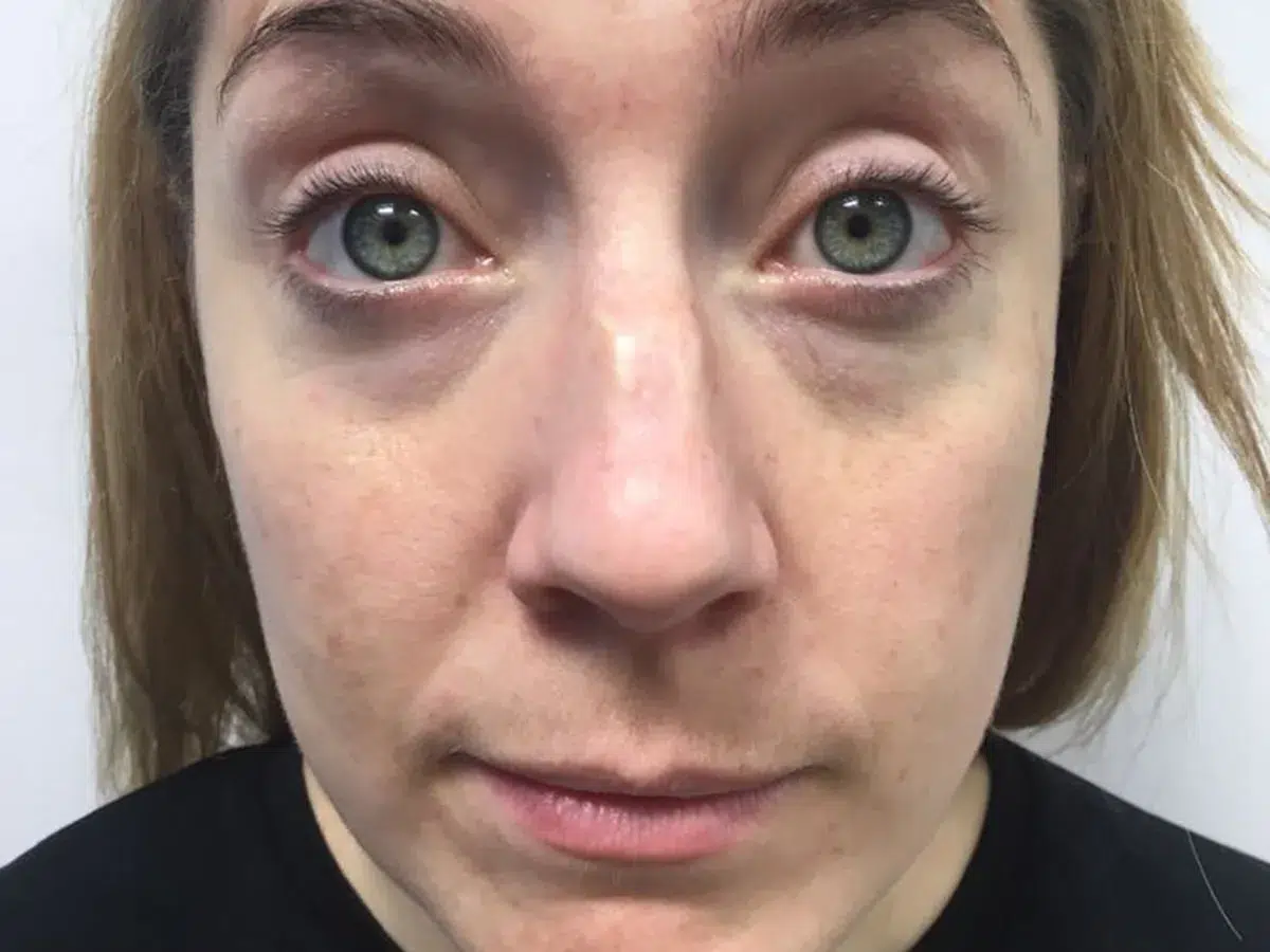 Forehead, frown and eye lines, before treatment at London Real Skin