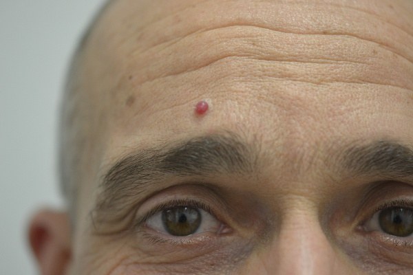 ba angioma before