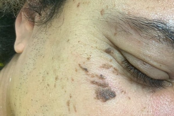 ba lesion before