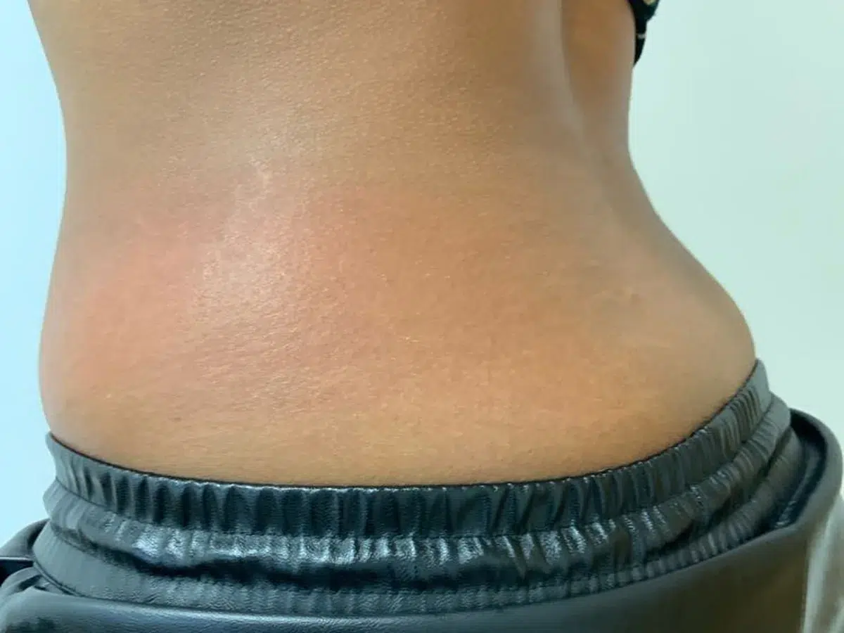 Contour through the waist and flank, before treatment at London Real Skin