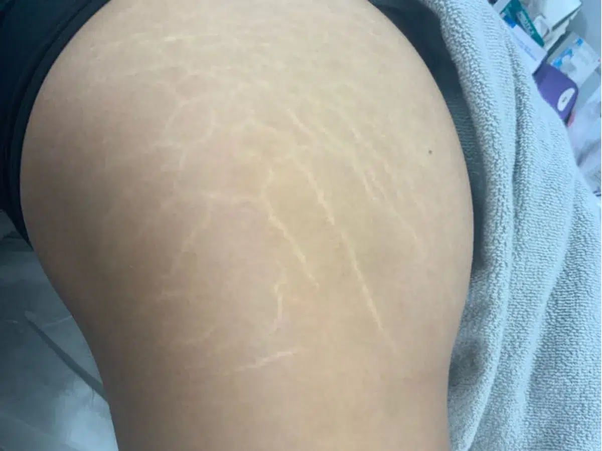 Stretch marks on the thigh, before treatment at London Real Skin