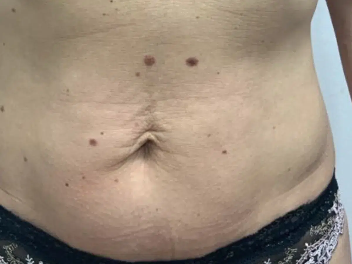 Loose skin across the abdomen, before treatment at London Real Skin