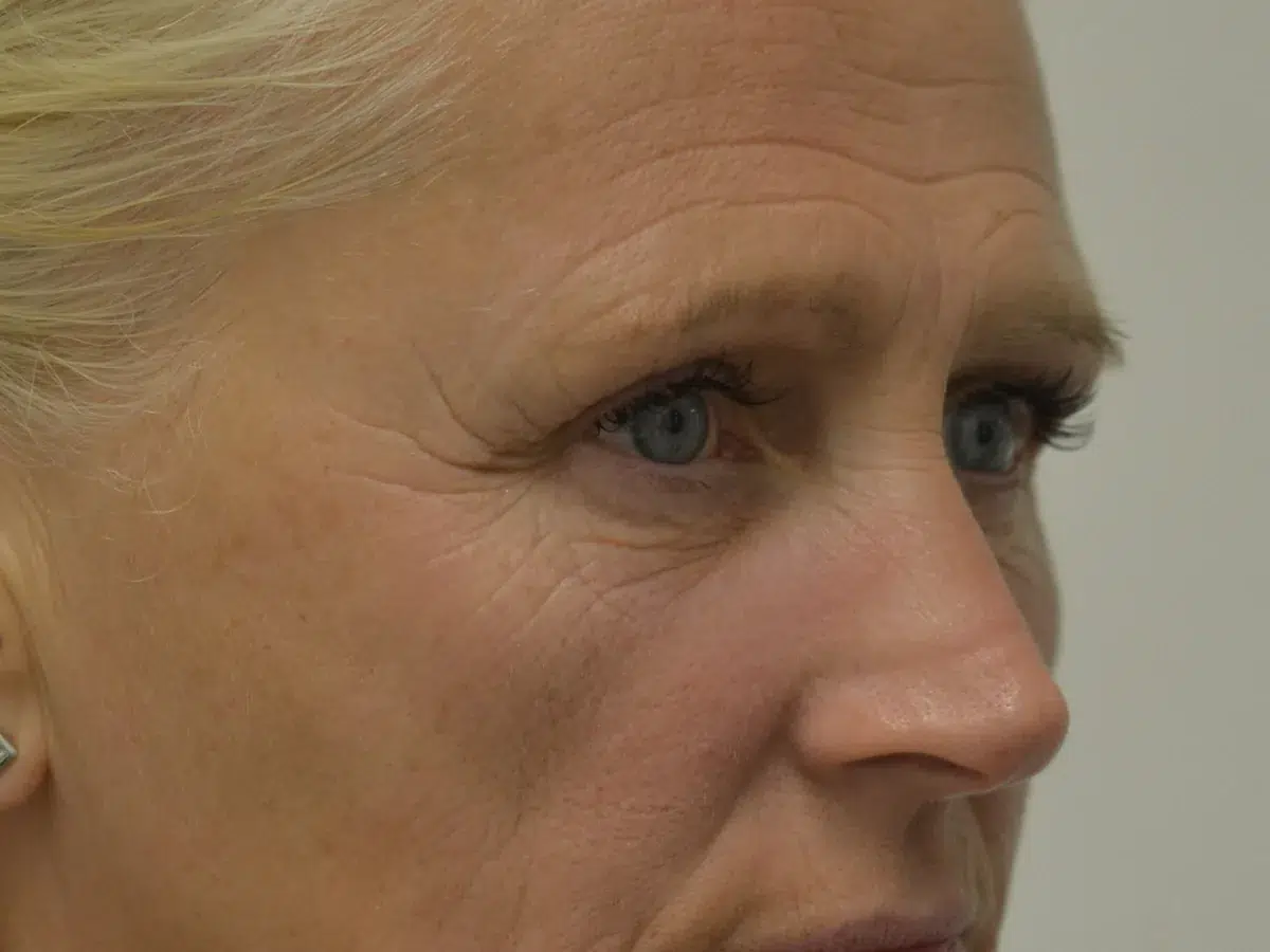 Cheekbone volume, before treatment at London Real Skin