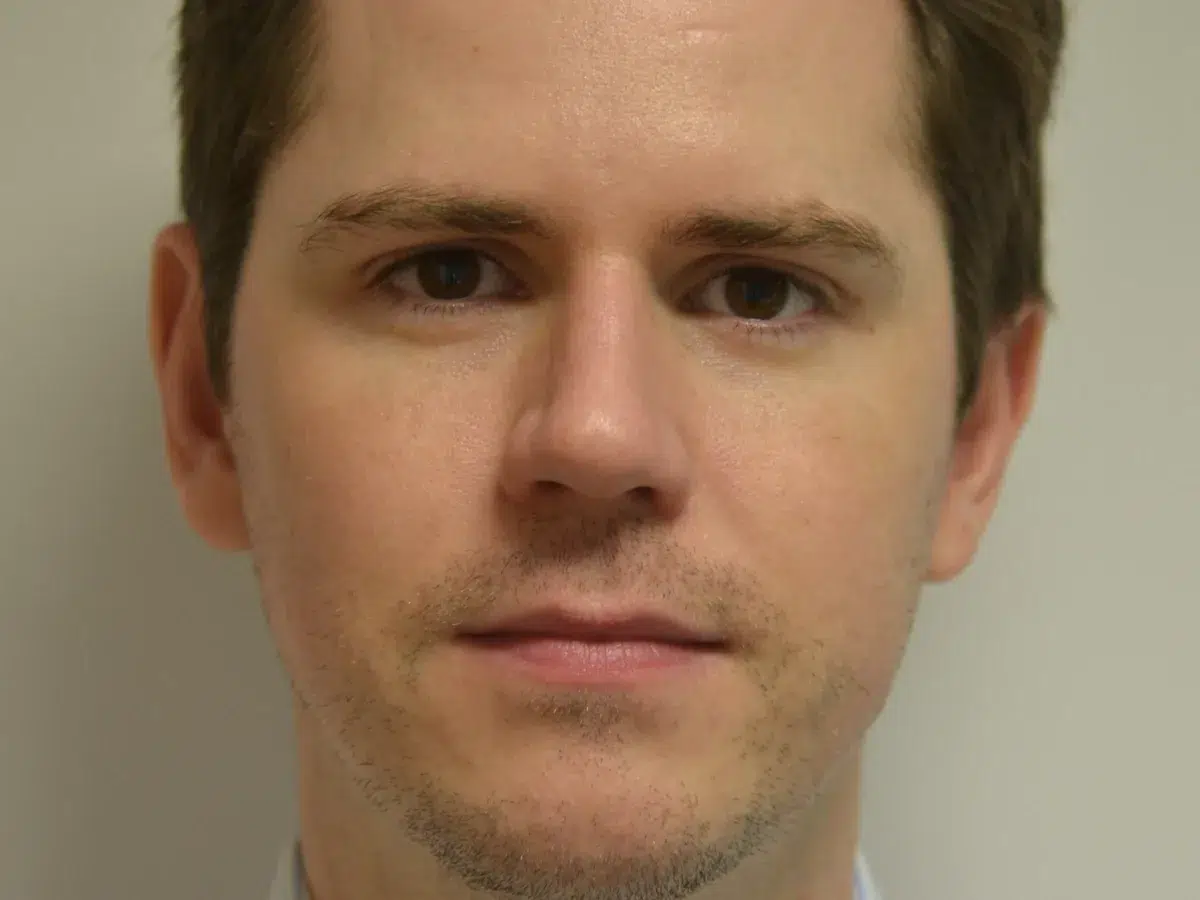 Jawline definition, before treatment at London Real Skin