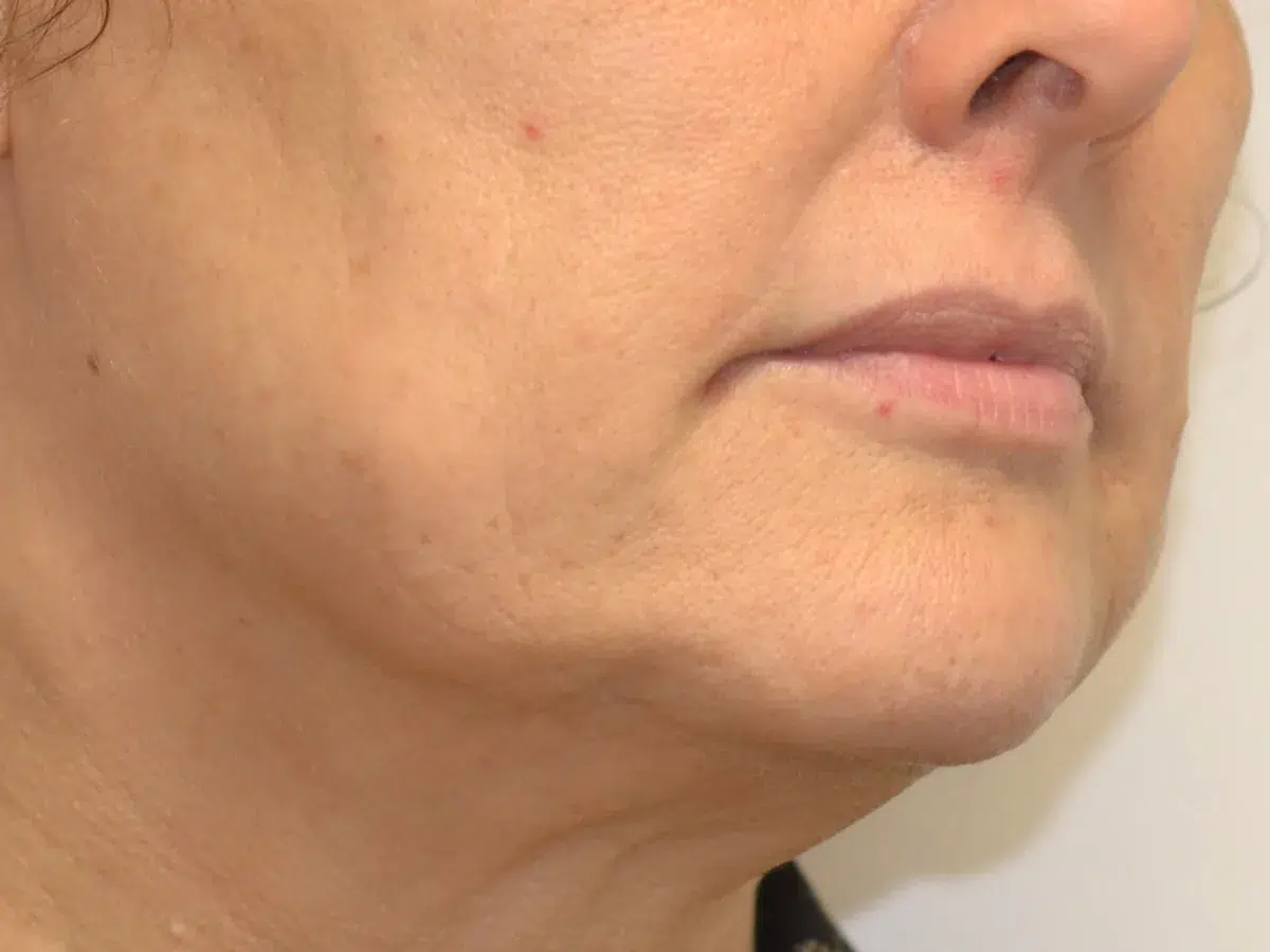 Early jowling along the jawline, before treatment at London Real Skin