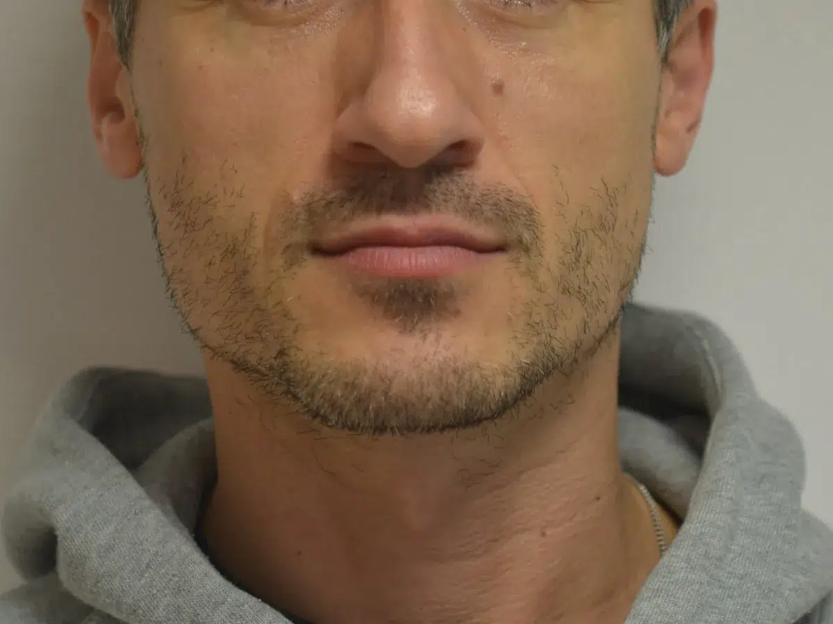 Subtle lip shaping, before treatment at London Real Skin