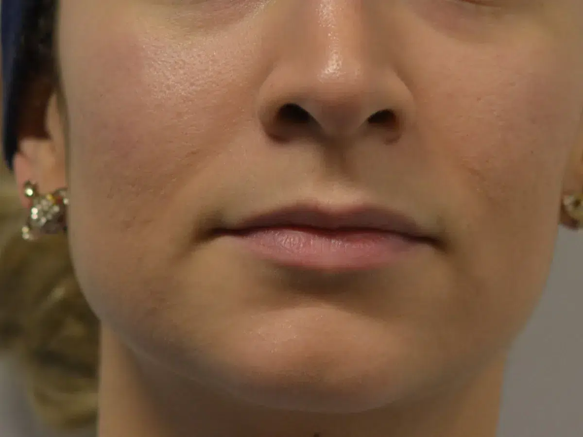 Lip definition and proportion, before treatment at London Real Skin