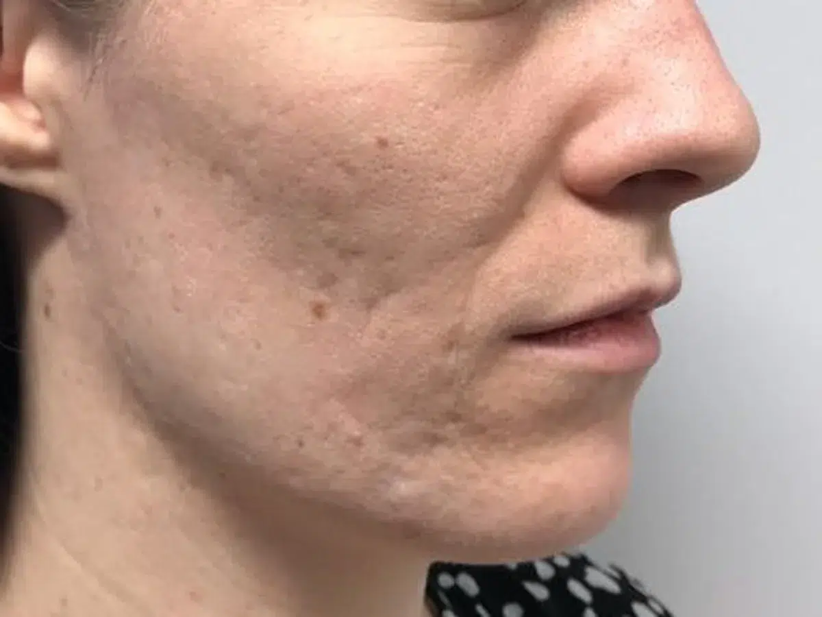 Depressed acne scars on the cheek, before treatment at London Real Skin