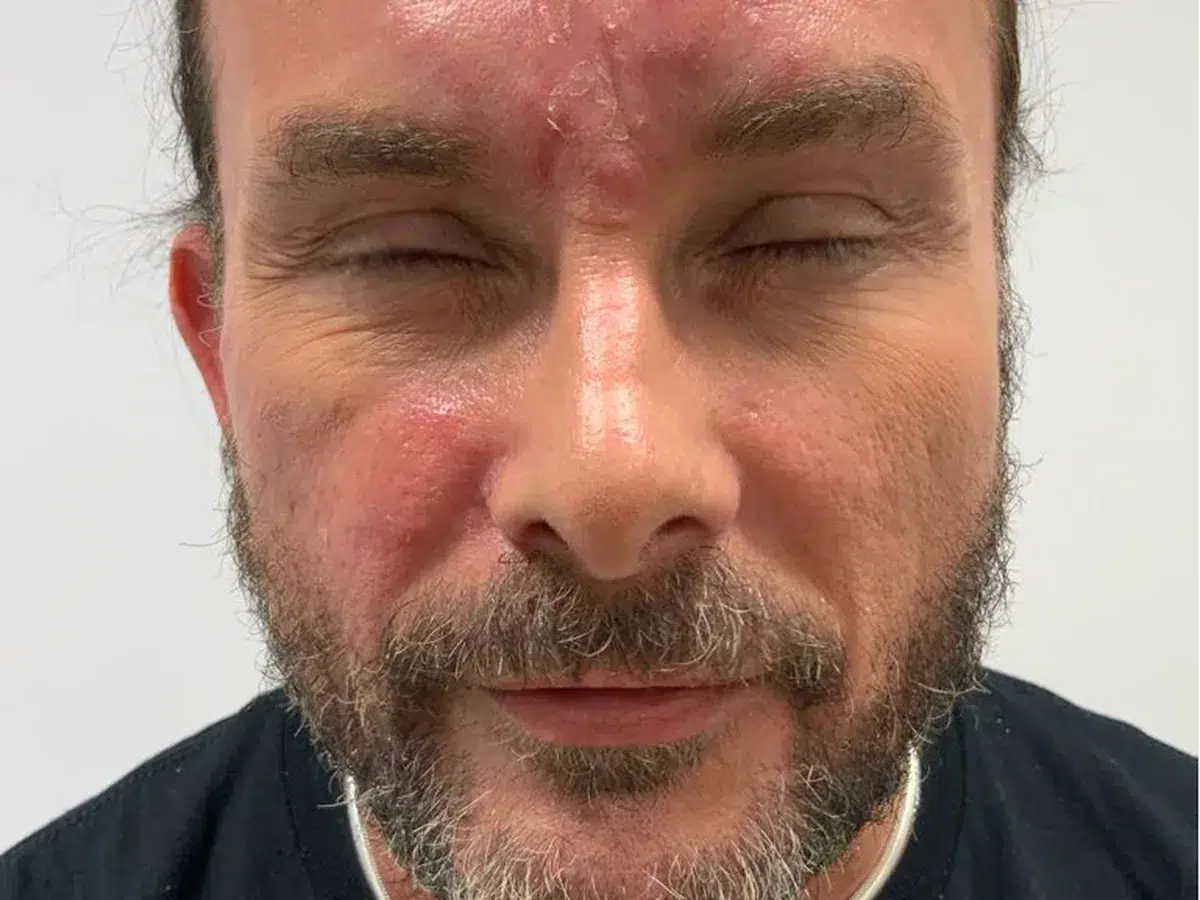Rosacea across the forehead and cheeks, before treatment at London Real Skin