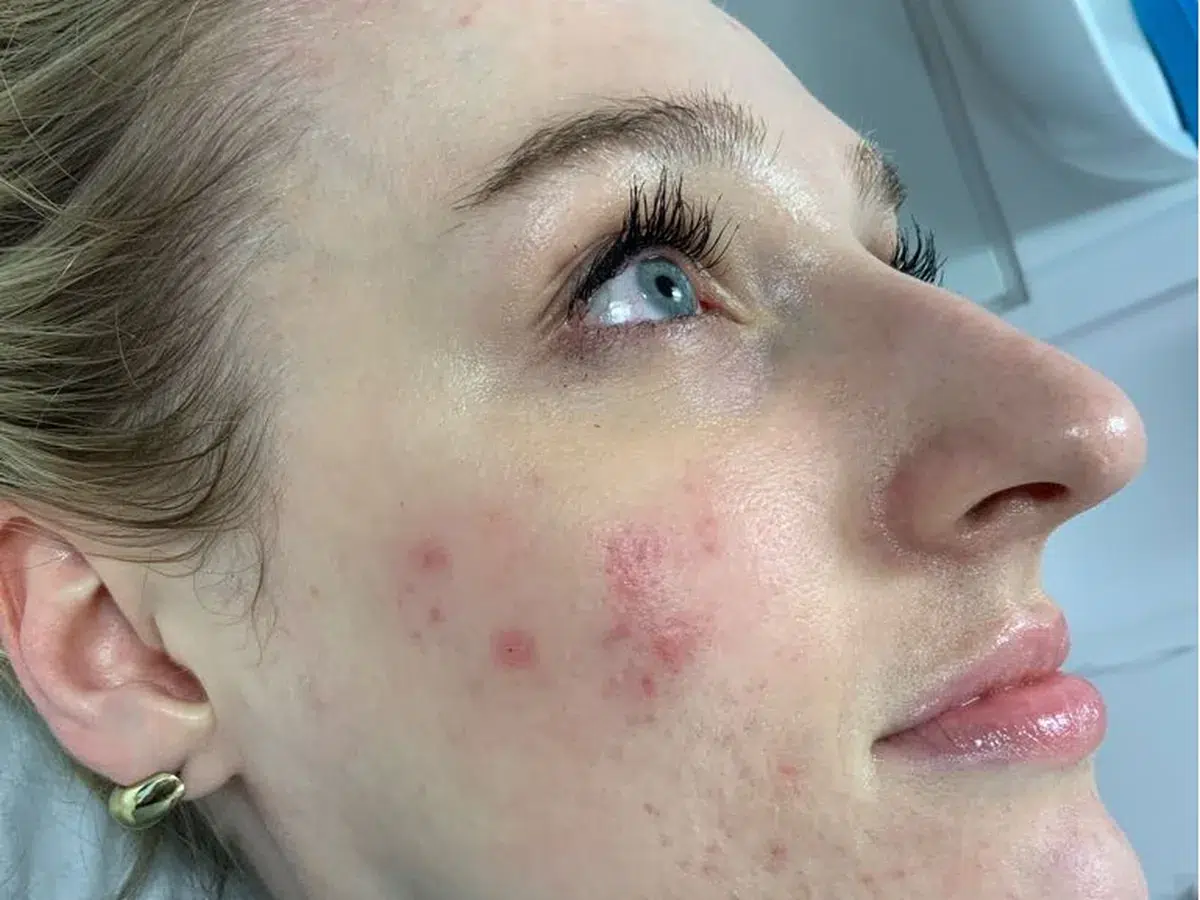 Inflamed papules and flushing, before treatment at London Real Skin