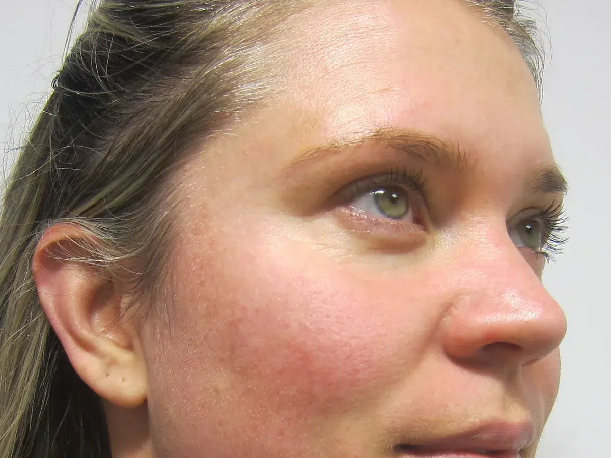 Persistent facial redness, before treatment at London Real Skin