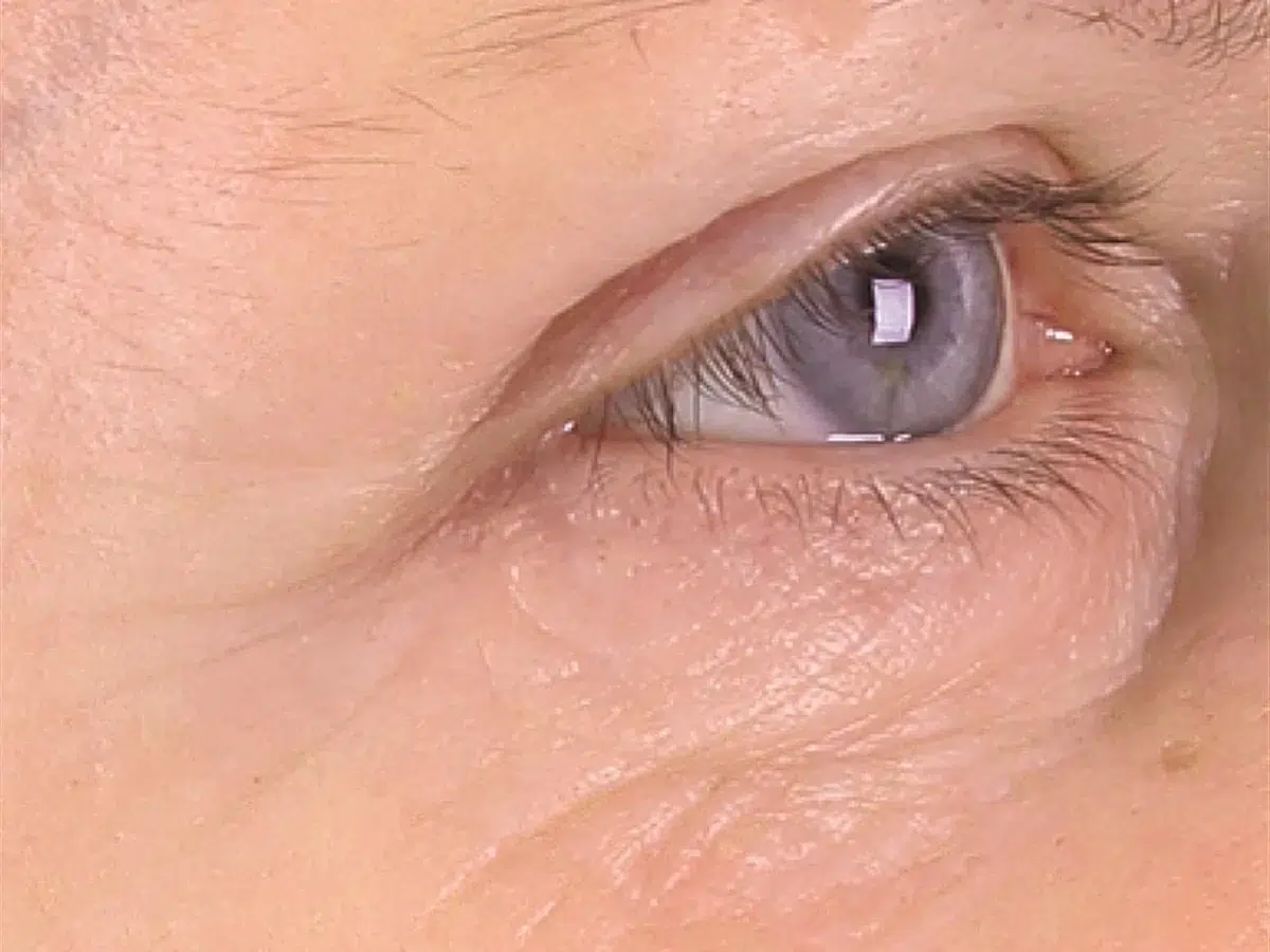 Crow’s feet and crepey eyelid skin, before treatment at London Real Skin