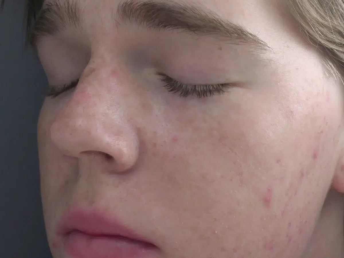 Breakouts across the cheek and jaw, before treatment at London Real Skin