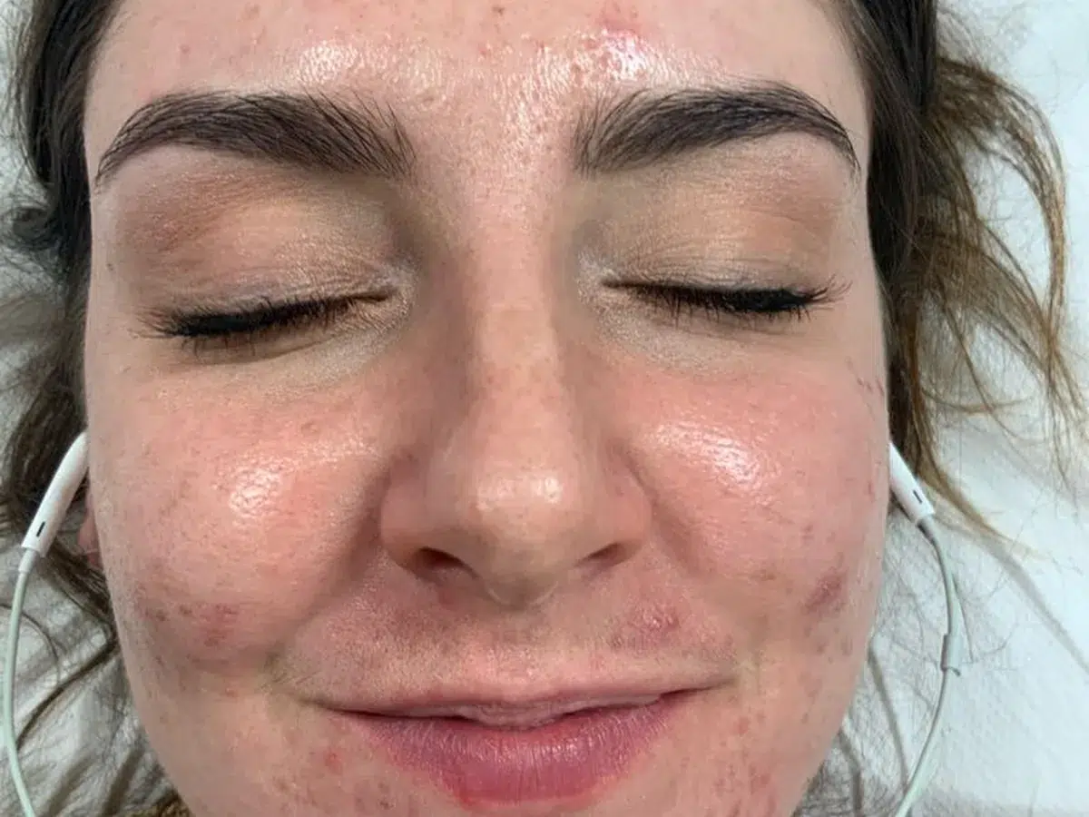 Widespread active acne, before treatment at London Real Skin