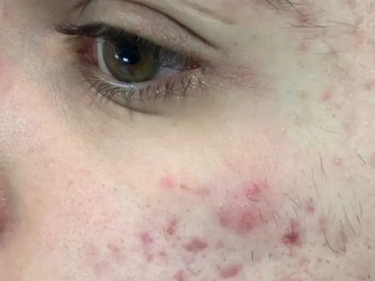 Active inflammatory acne on the cheek, before treatment at London Real Skin