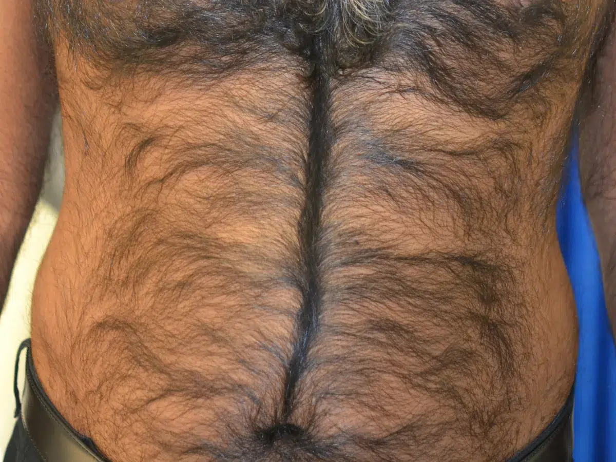 Dense chest hair, before treatment at London Real Skin
