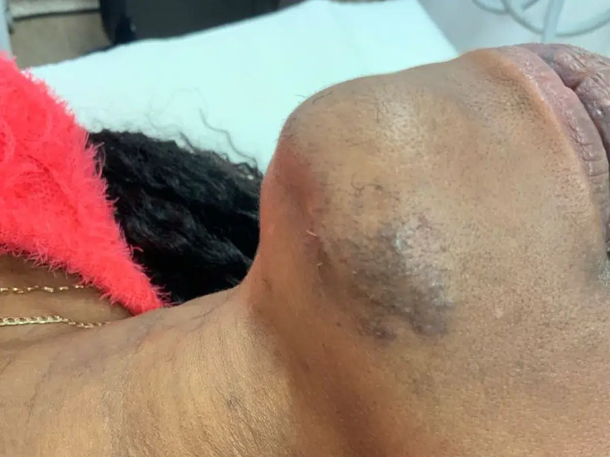 A dense patch of pigmentation on the neck, before treatment at London Real Skin