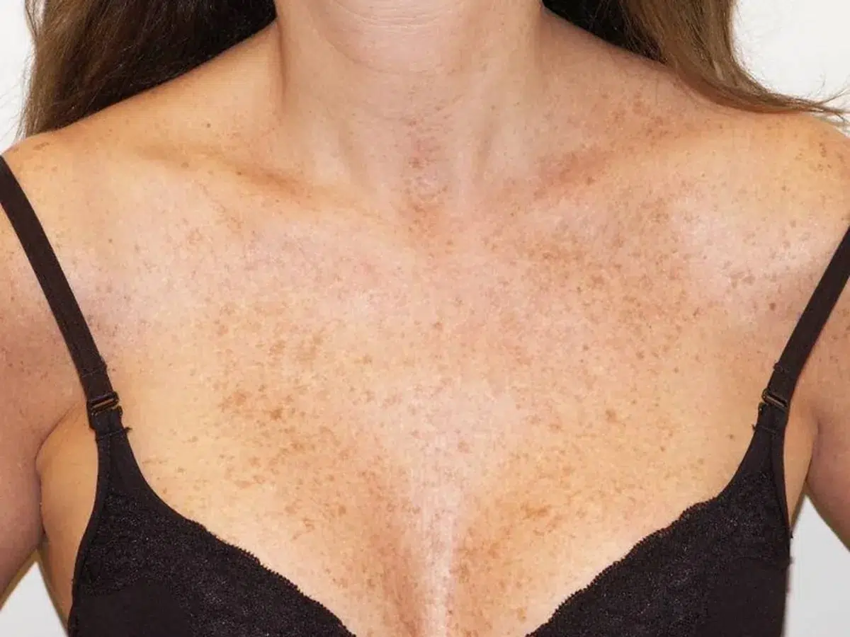 Sun-induced pigmentation on the chest, before treatment at London Real Skin