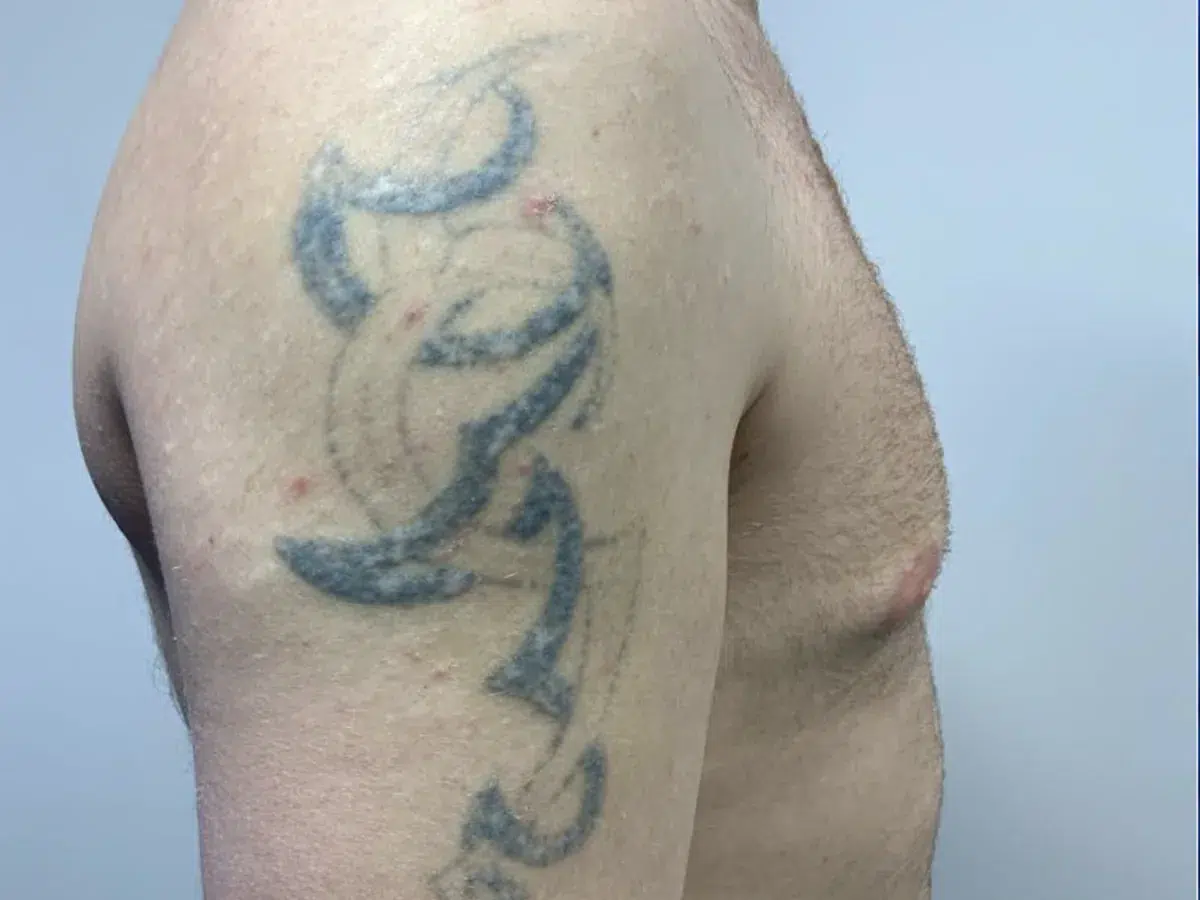 A tribal design, part-way through a course, before treatment at London Real Skin