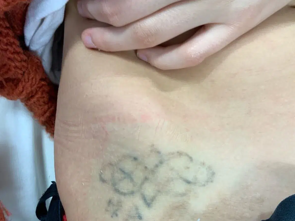 An older tattoo on the torso, before treatment at London Real Skin