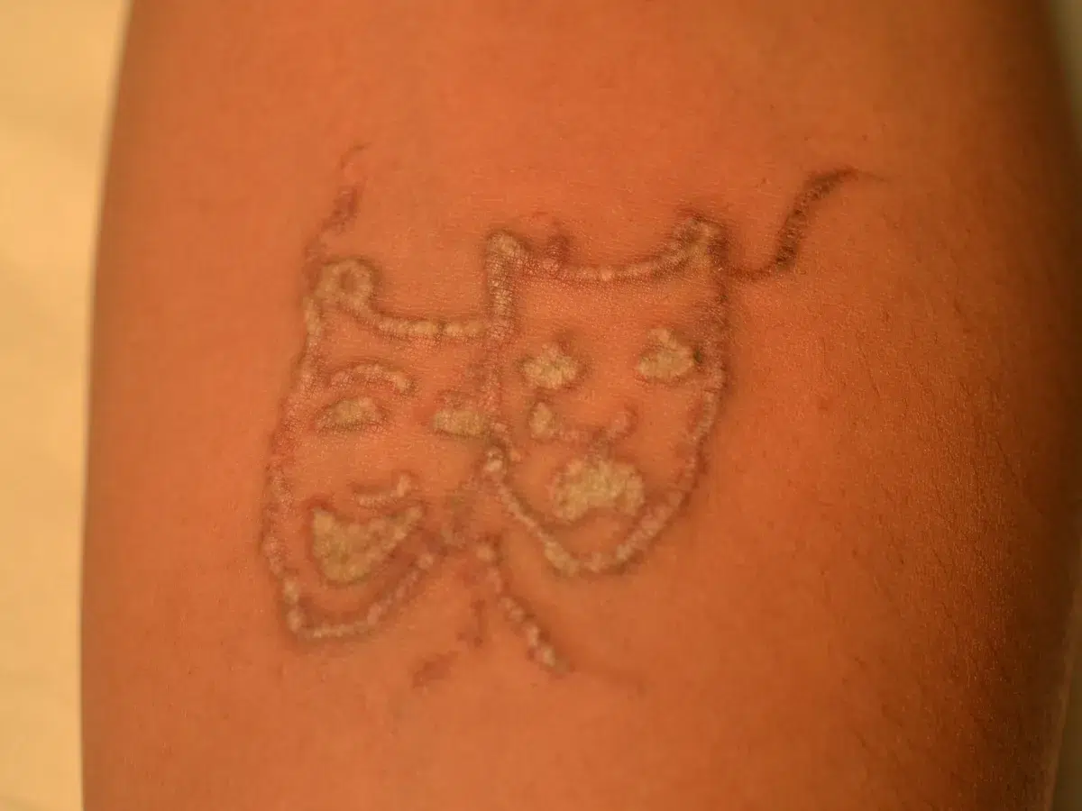 A dark arm tattoo, before treatment at London Real Skin