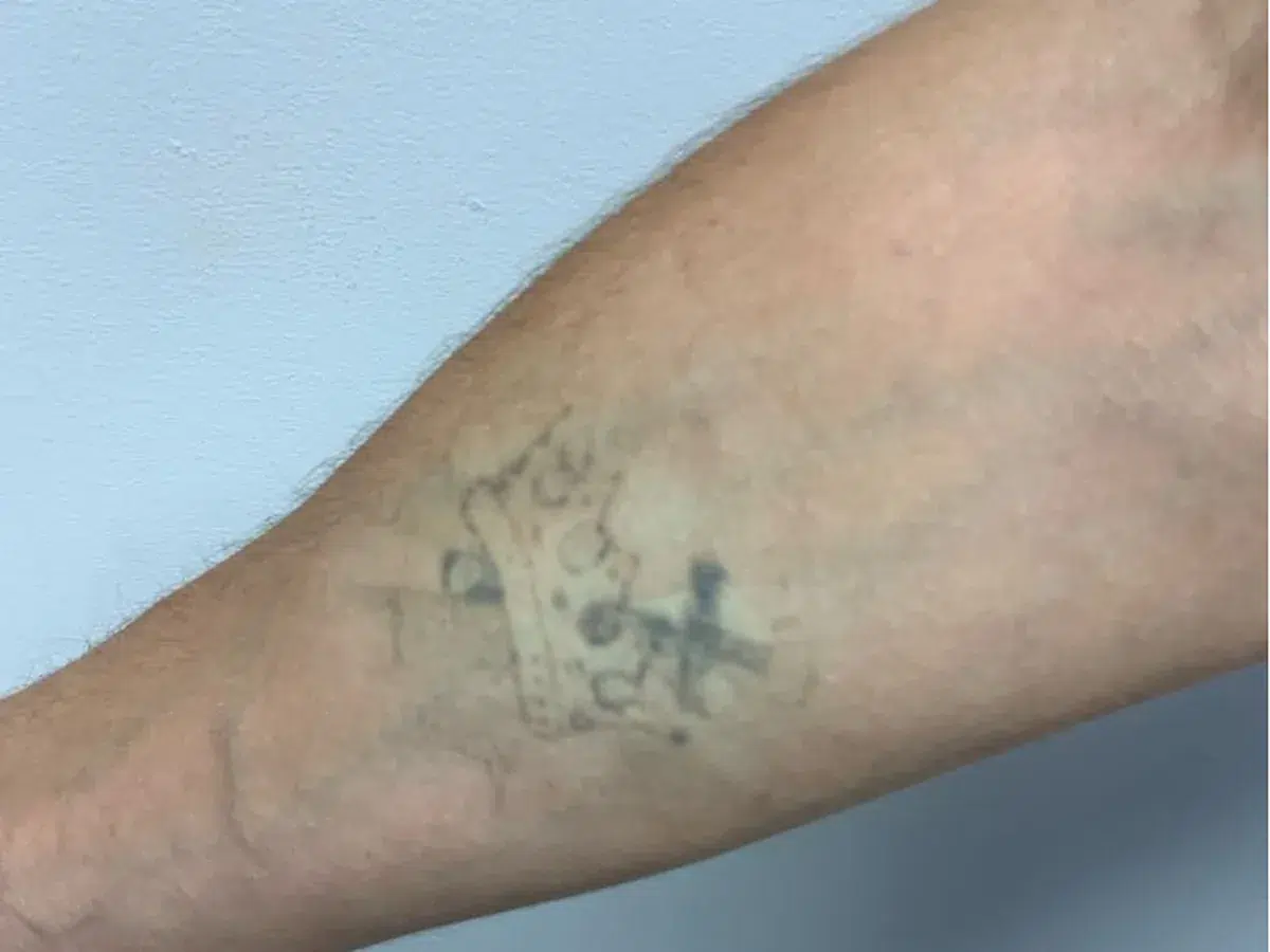 A small forearm tattoo, before treatment at London Real Skin