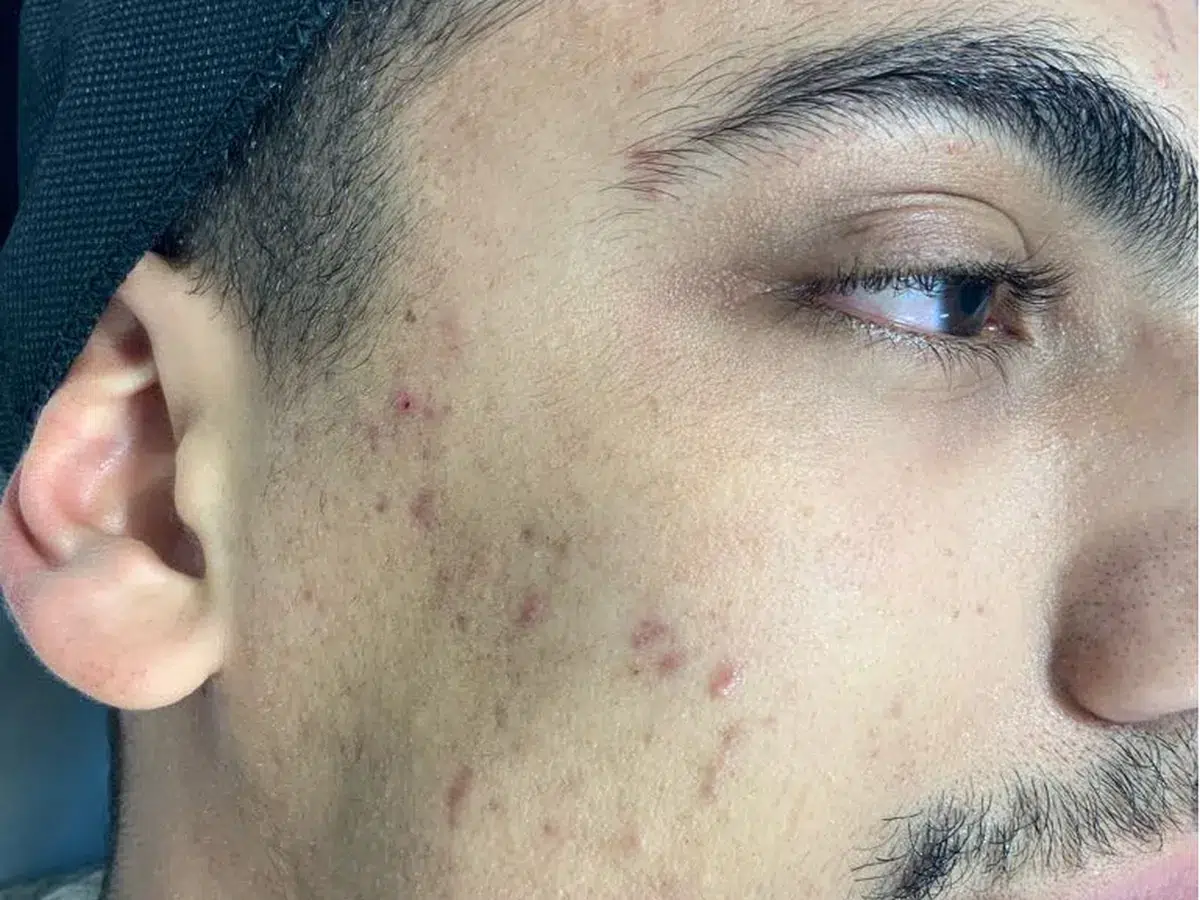 Breakouts and post-inflammatory marking, before treatment at London Real Skin