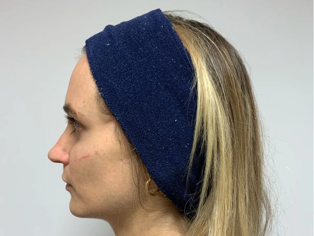 Overall clarity and tone, before treatment at London Real Skin