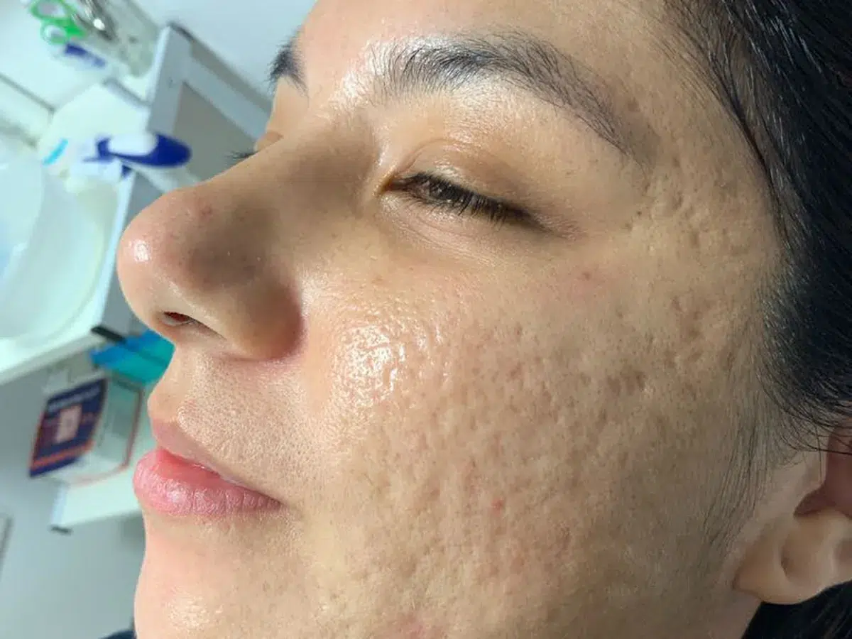 Textured acne scarring, before treatment at London Real Skin