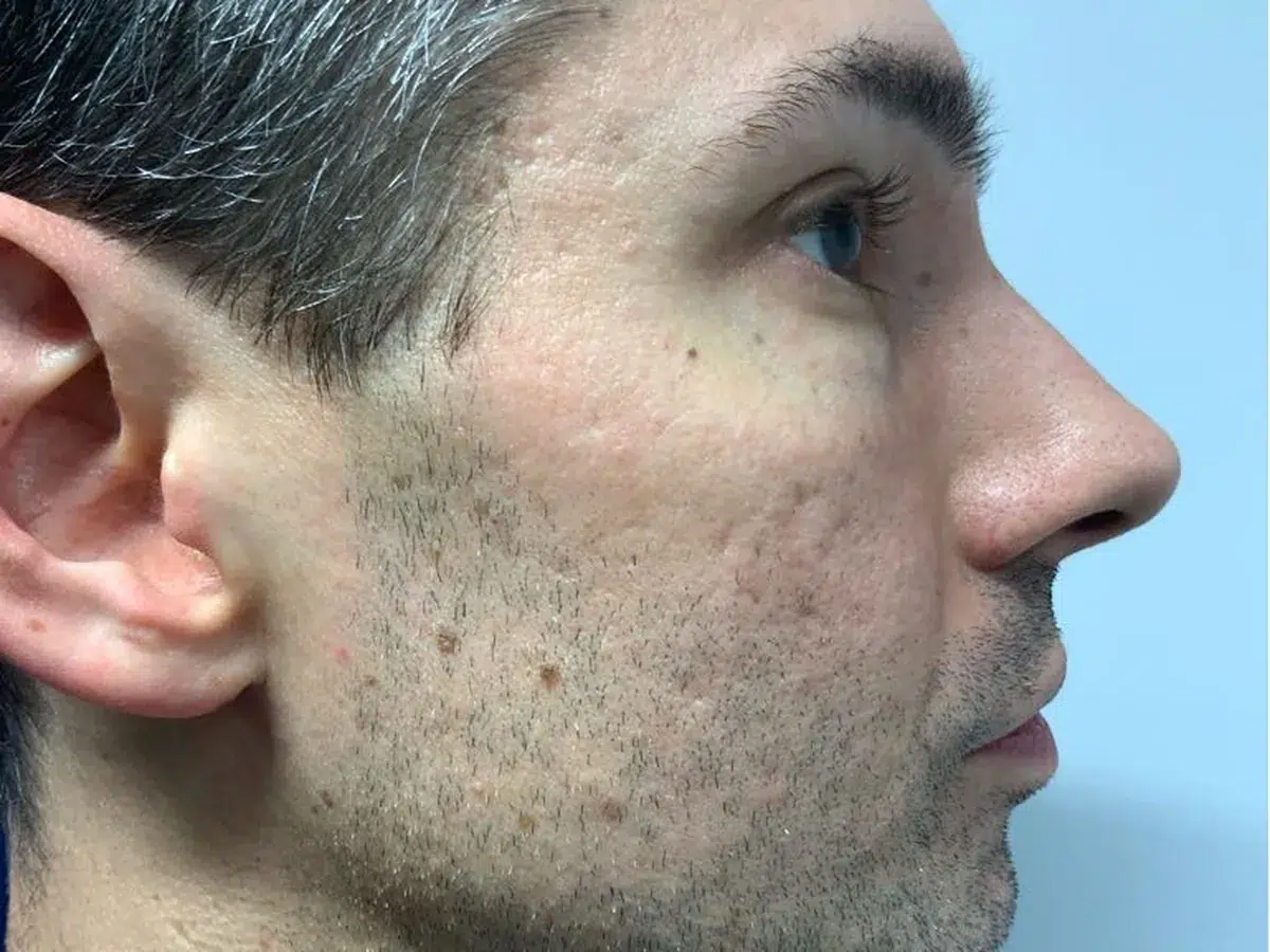 Acne scarring, combination treatment, before treatment at London Real Skin
