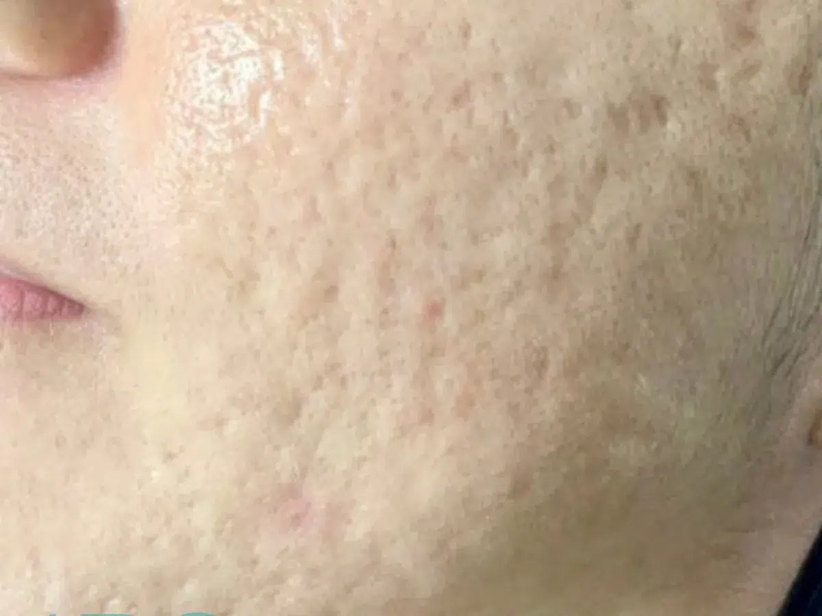 Pitted acne scarring on the cheek, before treatment at London Real Skin