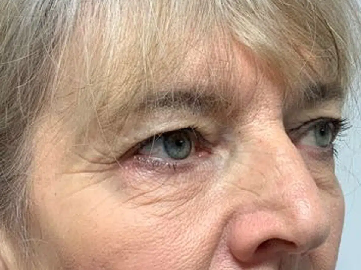 Excess upper eyelid skin, before treatment at London Real Skin