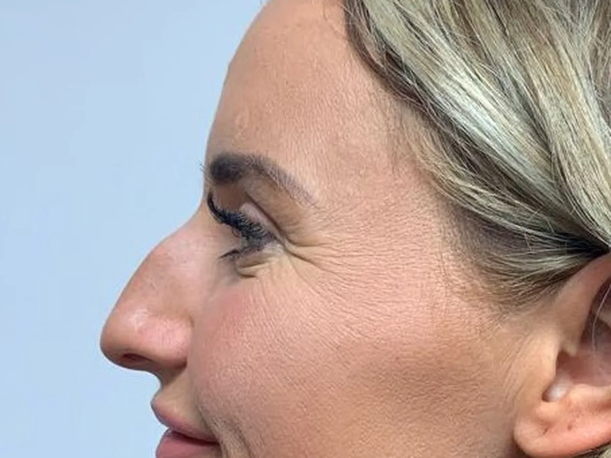 Bridge smoothed and tip lifted, before treatment at London Real Skin