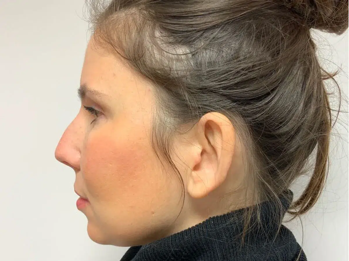 Bridge balanced against the tip, before treatment at London Real Skin