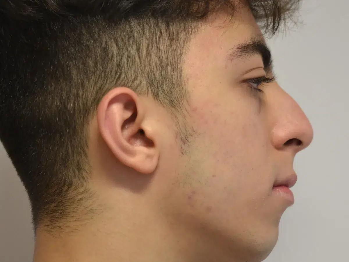A dorsal hump camouflaged, before treatment at London Real Skin